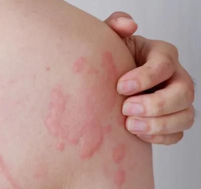 Ce este urticaria. Cauze și simptome pentru afecțiunea care afectează o persoană din cinci