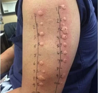 James a ignorat mâncărimile. Avea urticarie cronică, o afecțiune care poate dura ani